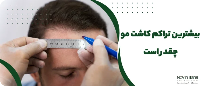 بهترین روش کاشت مو